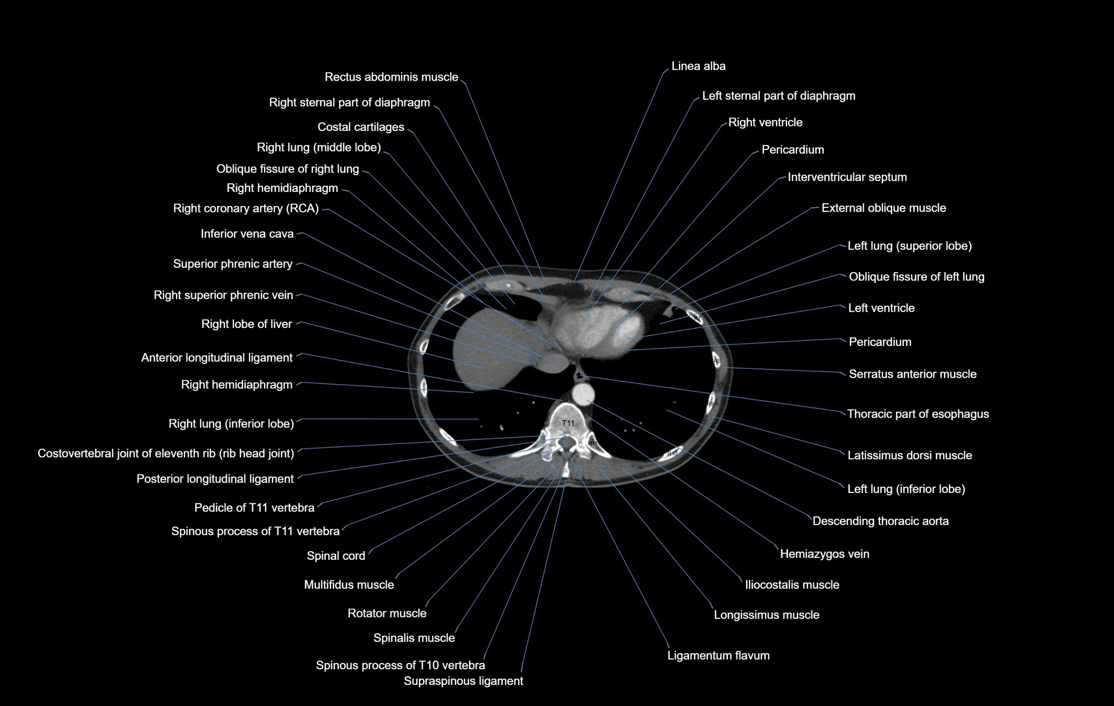 CT chest (thorax) soft tissue window labelled axial cross sectional anatomy radiology image-00098.webp